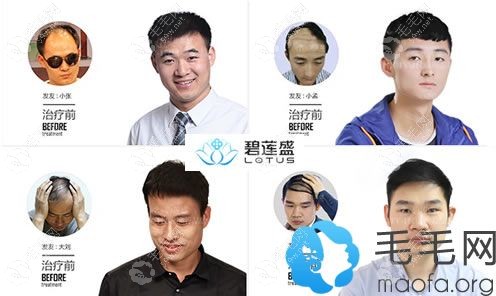 武汉碧莲盛植发治疗脱发的案例