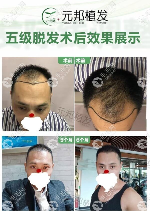 男士5级大面积脱发植发案例