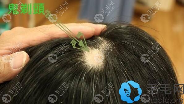 什么是斑禿以及它的表現特點