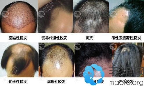 脱发的症状有哪些？