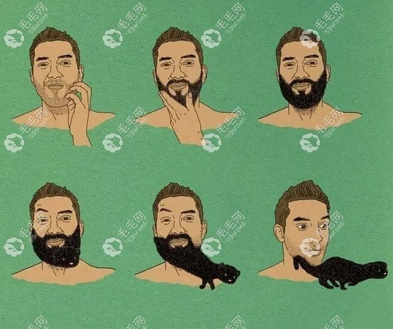 请问种植胡须后多久可以正常刮呢？