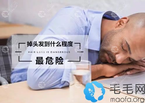 碧莲盛医生解说掉头发到什么程度较危险