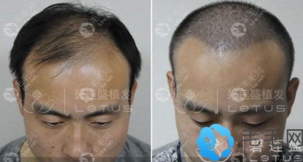 碧蓮盛尹梓貽醫(yī)生植發(fā)案例