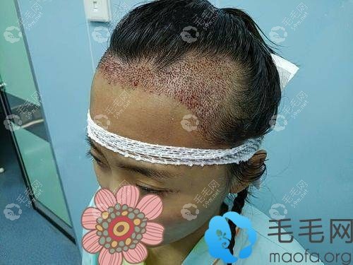 濟南藝星發(fā)際線種植即刻效果