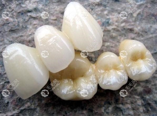 全瓷冠便宜和貴的區(qū)別主要在硬度不同