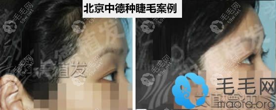 北京中德種植睫毛前后對(duì)比圖片
