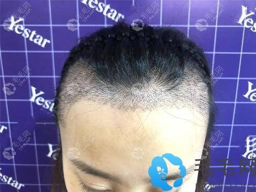 濟南藝星發(fā)際線種植1周效果圖