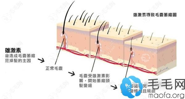 雄性激素導致毛囊萎縮示意圖