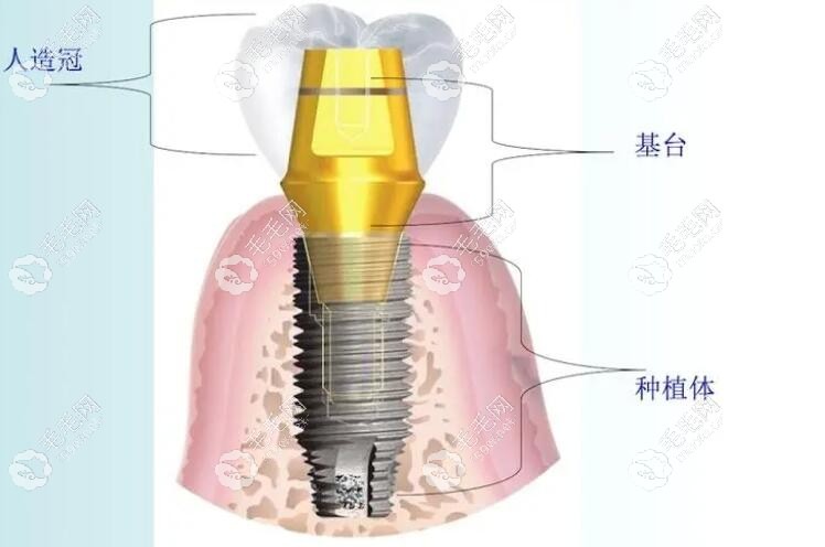 種植牙基臺(tái)的區(qū)別