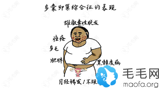多囊卵巢綜合征也會引起女性脫發(fā)