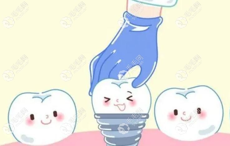種植牙動(dòng)畫圖