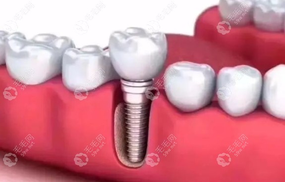 口腔種植