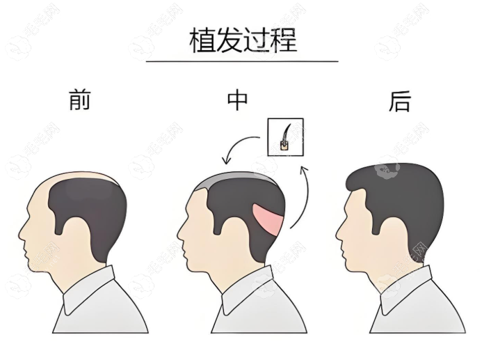 南宁发之友植发成效好