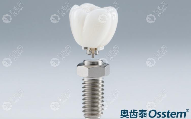 dio植體和奧齒泰植體哪個(gè)好