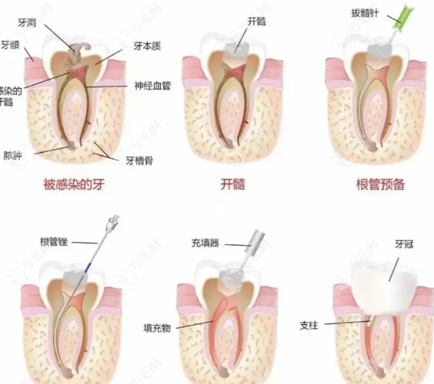 擔心會后悔給孩子做根管治療？別被焦慮左右