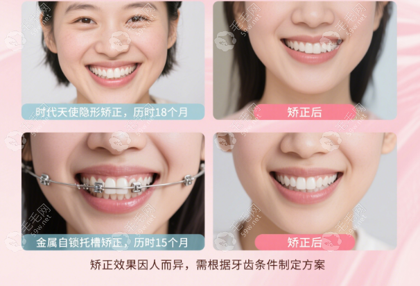 為什么選擇楊雪醫(yī)生做矯正