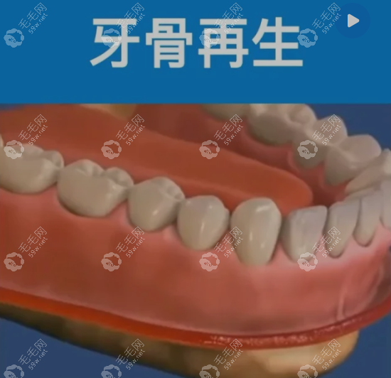 缺牙整顆再生牙10年內(nèi)會(huì)有嗎