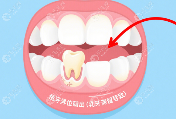 牙齦上長的“小牙齒”到底是什么