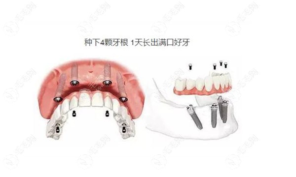 东营严选口腔种植牙性价比高