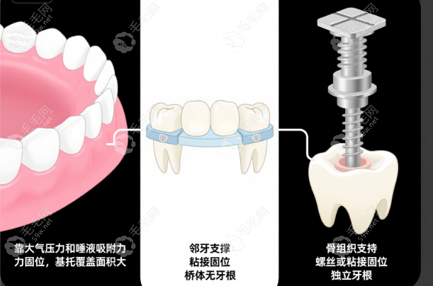 吸附式假牙/固定义齿/种植牙三大维度硬核对比