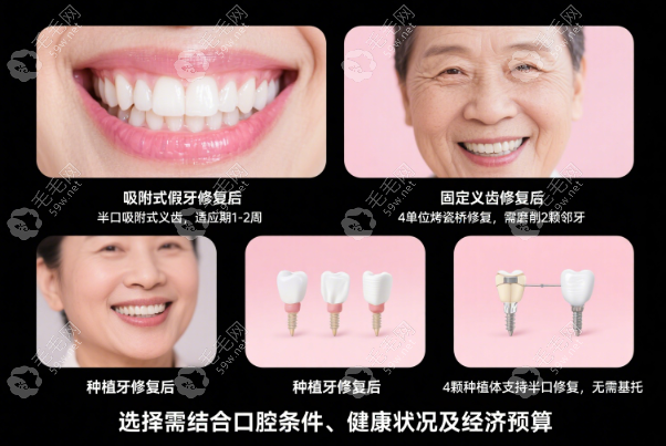 吸附式假牙/固定义齿/种植牙，半口缺牙到底选哪种？