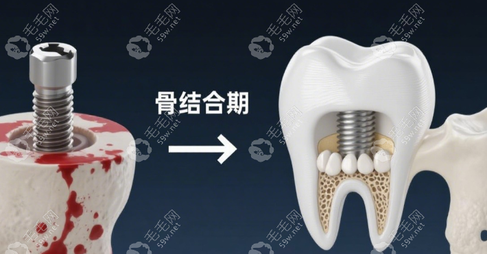 格倫菲爾種牙1880是全包價格嗎