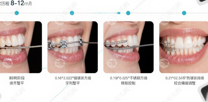 普特自鎖托槽的優(yōu)缺點(diǎn)59w.net
