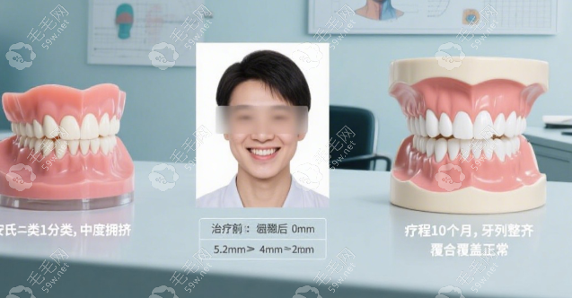 普特自鎖托槽屬于什么檔次