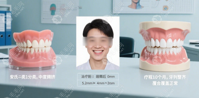 普特自鎖托槽7代價格