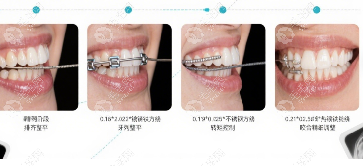 普特自鎖托槽7代系統(tǒng)的適用人群廣