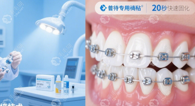 普特自鎖托槽5代和7代的價格59w.net