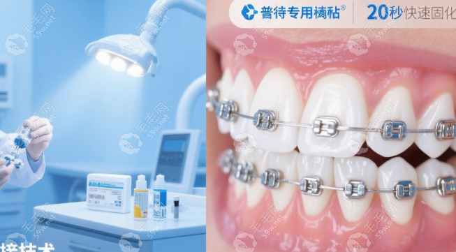 普特自鎖托槽是幾線正畸品牌