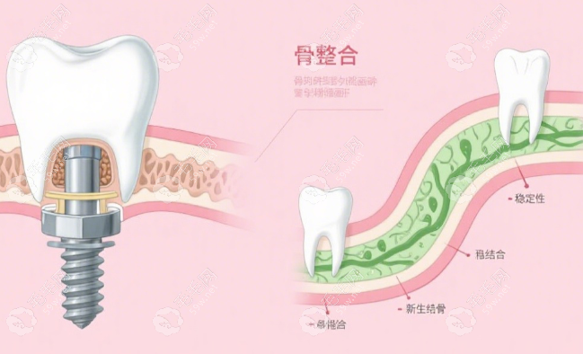 張家口市口腔醫(yī)院口腔種植