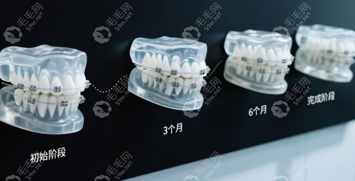 網(wǎng)上的牙齒矯治器是騙局