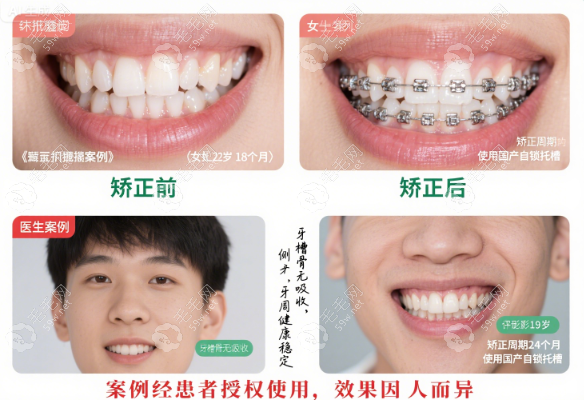 桐鄉(xiāng)松豐口腔矯正牙齒為啥口碑好