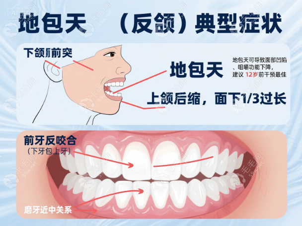 地包天手術(shù)是怎么做的