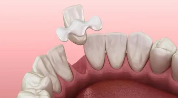 马里兰桥修复牙齿的优缺点www.59w.net