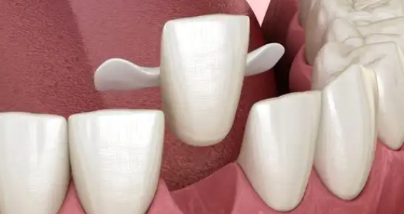 马里兰桥修复牙齿优点