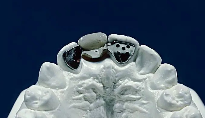 马里兰桥修复牙齿缺点