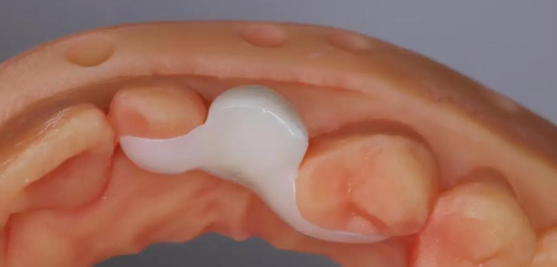 马里兰桥修复牙齿操作流程