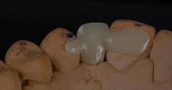 马里兰桥修复牙齿常见误区辨析