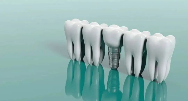 创英种植体的质量