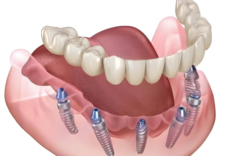 半口半固定种植牙是什么意思?和活动假牙比稳定性强、清洁方便
