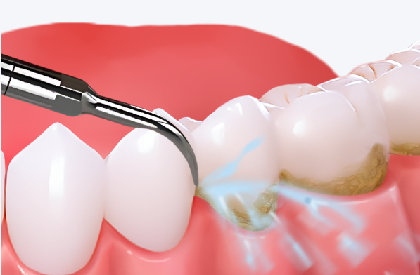 常见口腔问题及治疗方法