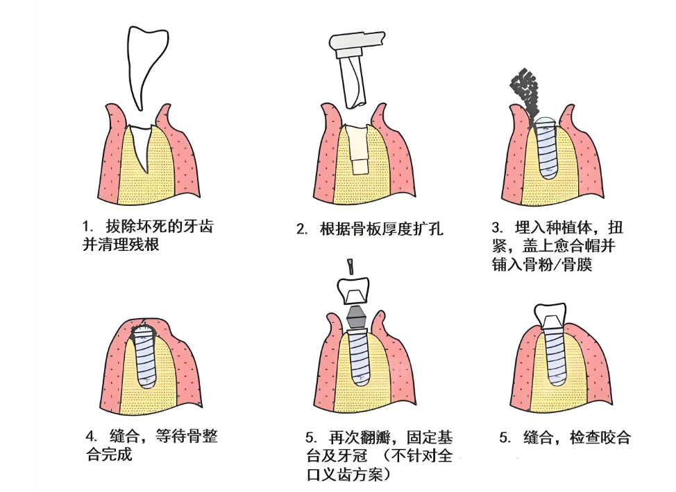 杭州中德口腔医院种植牙