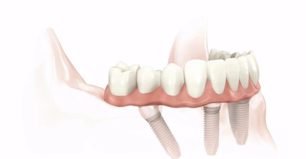 北京通州种植牙哪个医院种得好www.59w.net