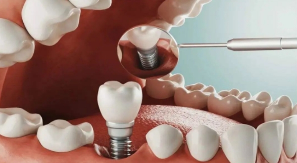 北京石景山种牙费用