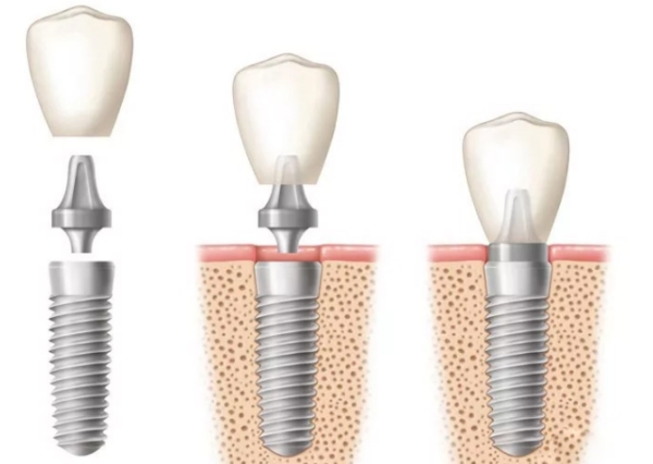 北京石景山种牙材料