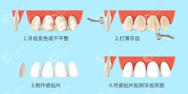 白牙吖全瓷贴面价格
