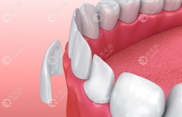 白牙吖全瓷贴面是正规品牌不是杂牌，一颗2980元起不算贵